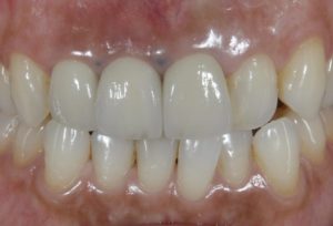 下関市のおおむら歯科医院にて、前歯のインプラント治療を行った後の画像
